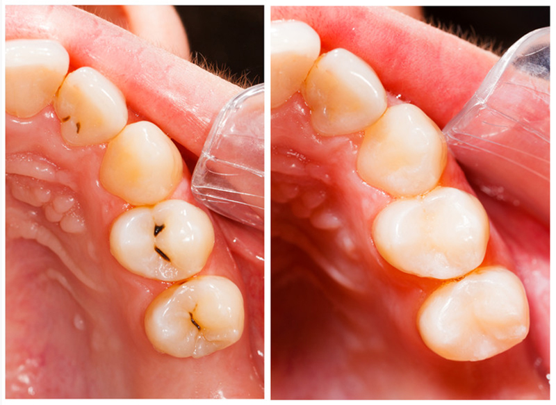Fillings Lynden, WA
