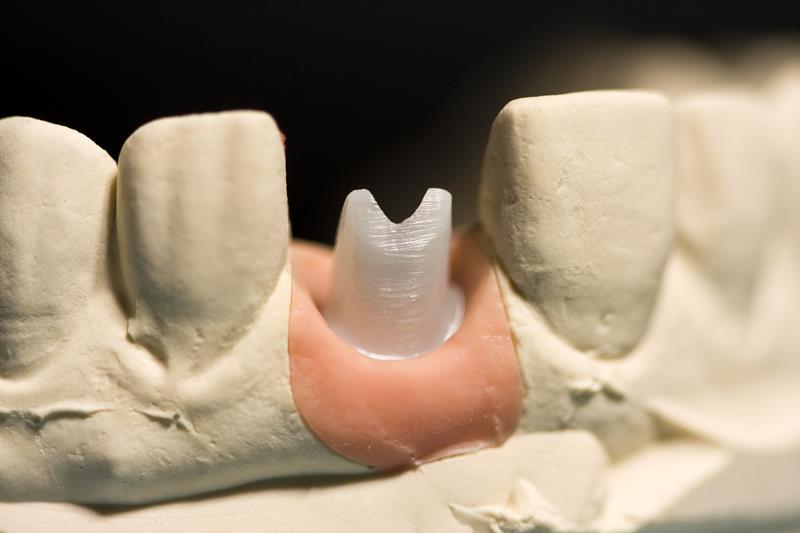 Implant Restoration Lynden, WA