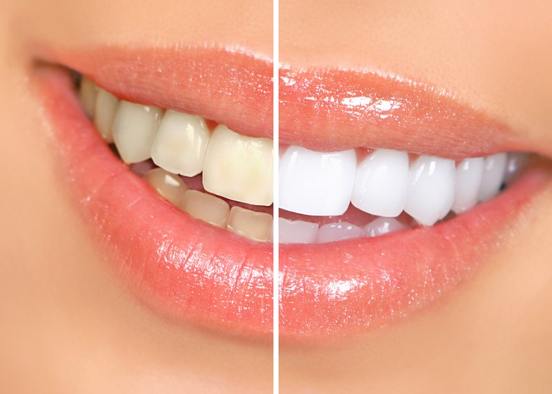 Teeth Whitening Lynden, WA