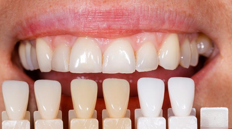 Veneers  Lynden, WA
